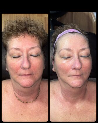 Before and after at Luminous Skin Tech