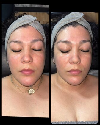 Before and after at Luminous Skin Tech