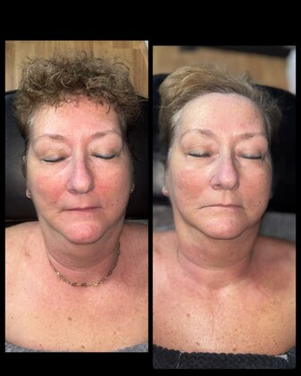 Before and after at Luminous Skin Tech